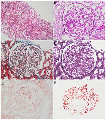 Case Report: Membranous Nephropathy Secondary to Cobalamin C Disease